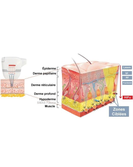 HIFU, l'Ultrason-Focalisé Dermopro