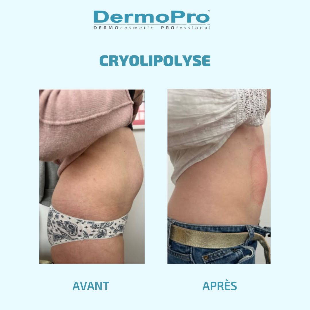 Avant  Après Cryo (1).jpg